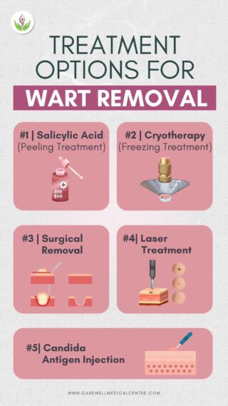 Treatment Options for Wart Removal