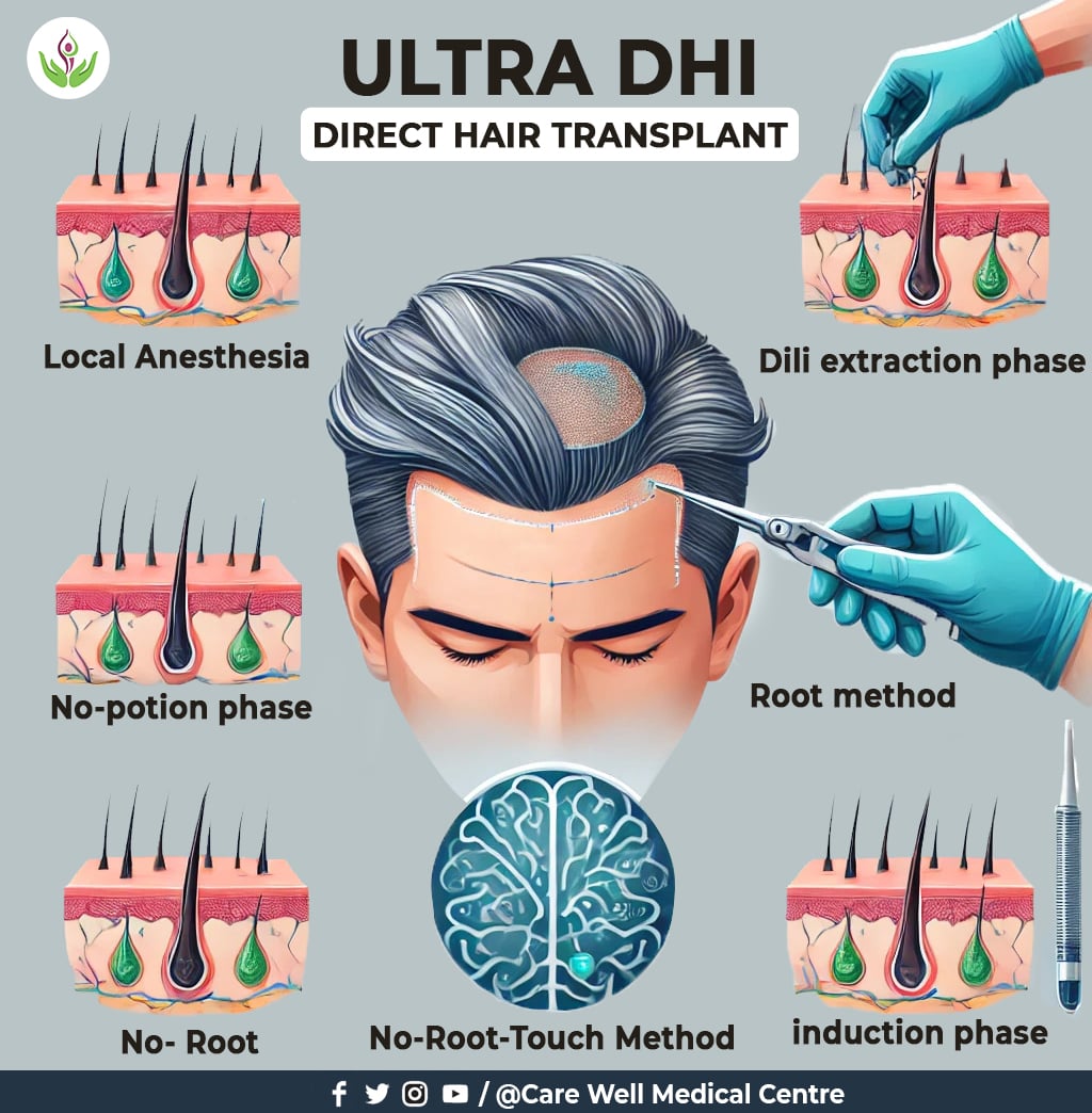 Ultra DHI Hair Transplant process 